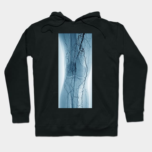 Peripheral vascular disease in diabetes (C029/9941) Hoodie by SciencePhoto